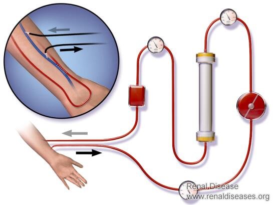 Does Hemodialysis Remove Ammonia