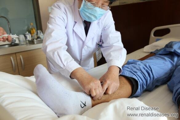 Does Leg Swelling Occur After Having Kidney Dialysis