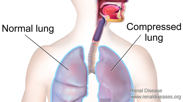 Pleural Effusion for Diabetic Nephropathy: What to Do