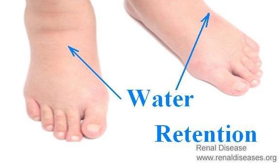Why Would You Get Fluid Retention During Dialysis