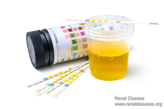 How Long Does It Take for Proteinuria to Damage the Kidneys