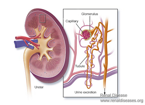 Does Acute Glomerulonephritis Have A Cure
