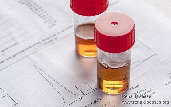 Proteinuria Is Mainly Due to This Part of Kidney Is Damaged