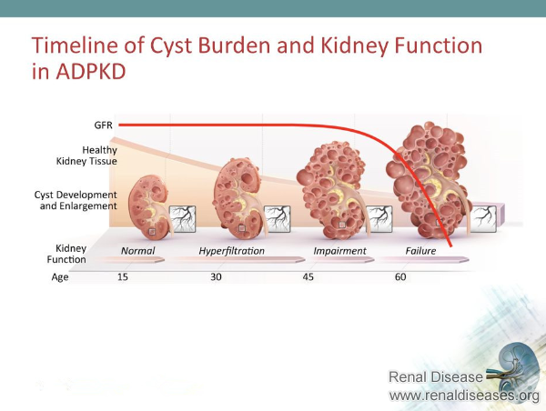 How Many Stages Can Polycystic Kidney Disease (PKD) Be Divided