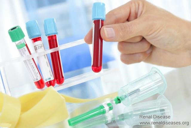 High Blood Creatinine Level May Be Not A Bad Thing