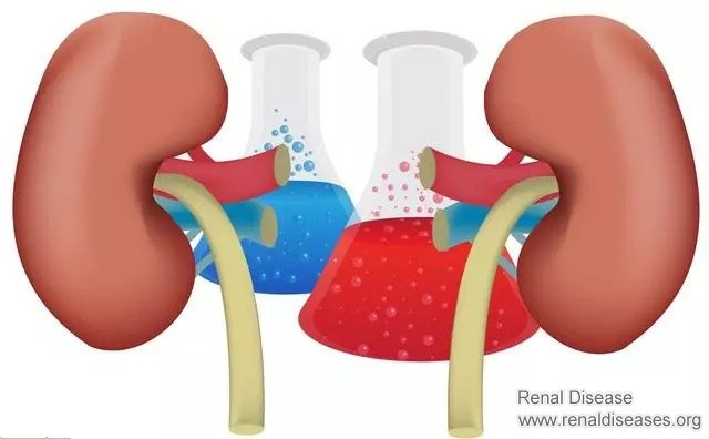 How to Protect Kidneys and Prevent Uremia for Glomerulonephritis Patients