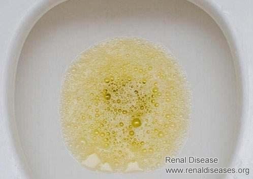 What to Do if Your Proteinuria Does Not Turn Negative for A Long Time