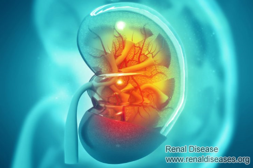 Can Scar Tissue Be Removed from Kidneys for FSGS Patients