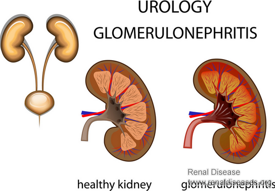 Is Chronic Glomerulonephritis Reversible