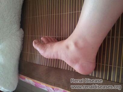Four Abnormalities Indicate Diabetic Nephropathy