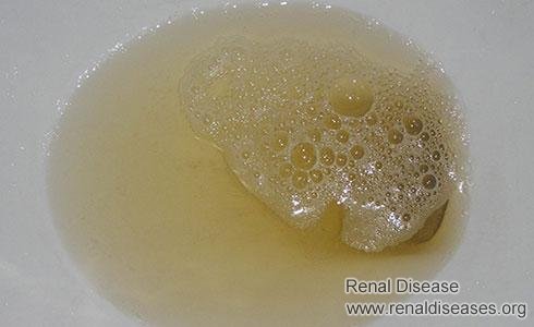 Four Abnormalities Indicate Diabetic Nephropathy