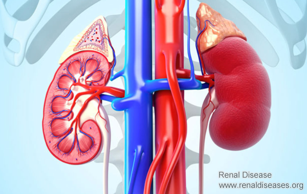 How Can Glomerulonephritis Develop to Nephrosis