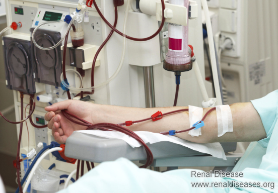 Is Dialysis Necessary for Stage 4 Kidney Disease
