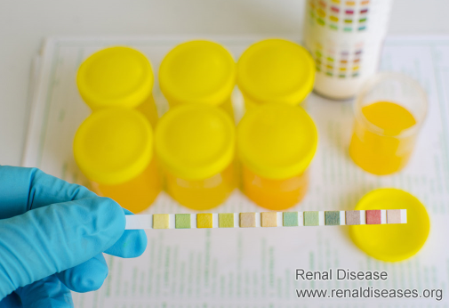IgA Nephropathy and Protein Leakage: What Is the Possible Treatment