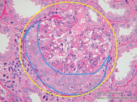 Crescent Nephritis — The Most Dangerous Form of Kidney Disease