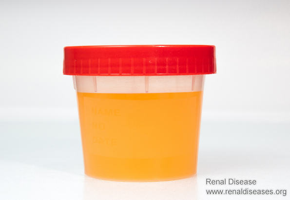 How to Control Protein Loss for Diabetic Nephropathy Patients