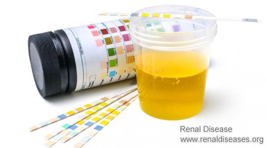 How to Reduce Proteinuria for Lupus Nephritis Patients