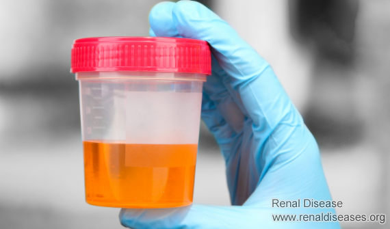 Proteinuria Is Refractory? It May Due to the Following 4 Points