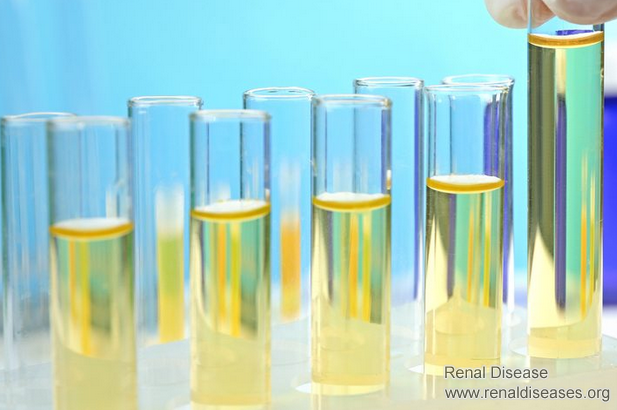 When Proteinuria Is Reduced to This Level, It Does Not Cause Kidney Damage