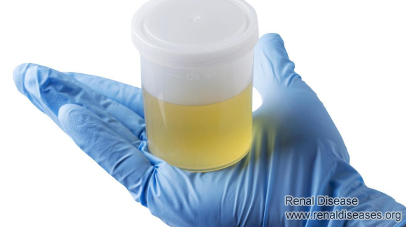 A Single Urine Test Can Predict the Risk of Renal Failure