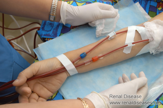 There Are 3 Situations in Which Early Dialysis Is More Likely to Lead to Kidney Failure