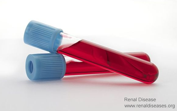 It Is Not Difficult to Reduce Creatinine with These 2 Methods