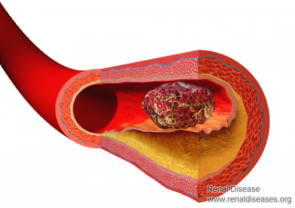Why Are Nephrotic Syndrome Patients More Prone to Thrombus