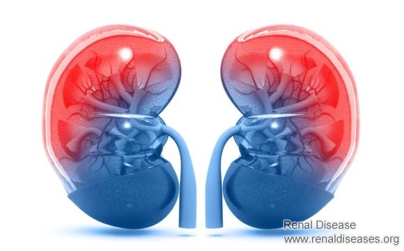 These Kidney Disease Is Incurable, and Will Progress into Uremia