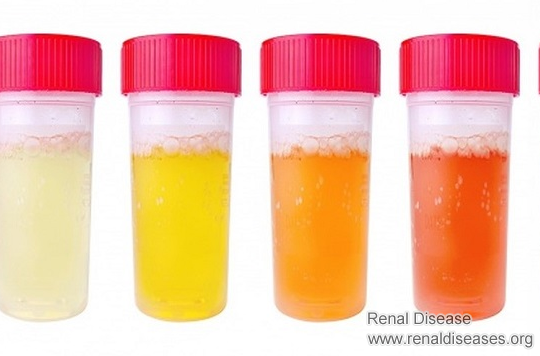 If You Have 4 Changes in Urine and 2 Pains, Your Creatinine May Increase