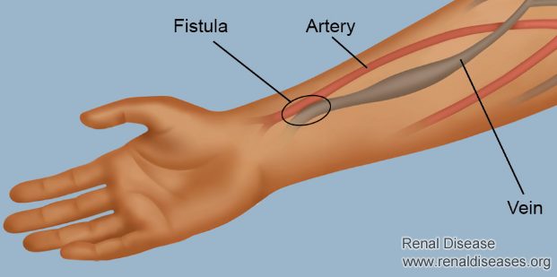 How to Protect Blood Vessels of Dialysis Fistula