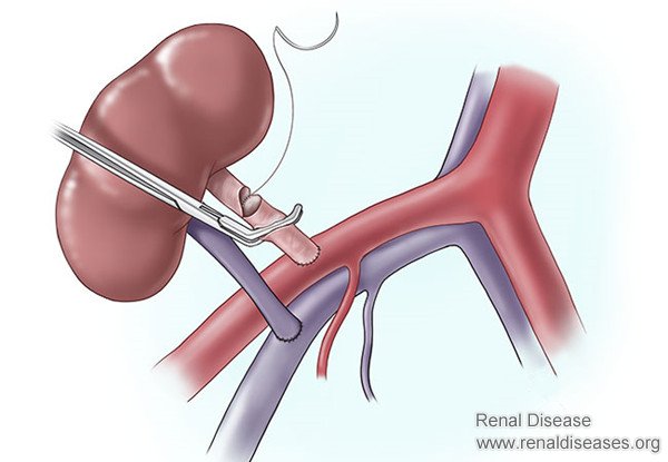 Do You Have A Correct Understanding About Kidney Transplant
