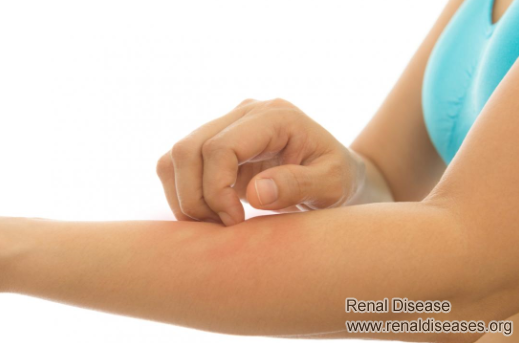 How to Control Itching due to High Creatinine Level