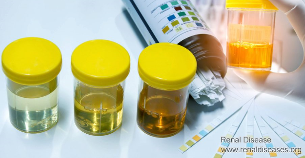 Proteinuria 1+, 2+ and 3+: What Does It Mean Respectively