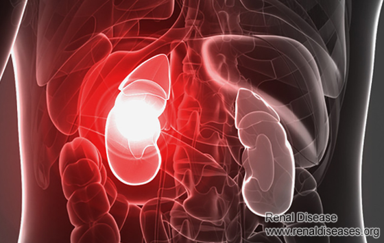 How to Repair A Failing Kidney Without Dialysis