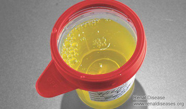 Do You Need to Change Medication if Proteinuria Gets Relapse Frequently