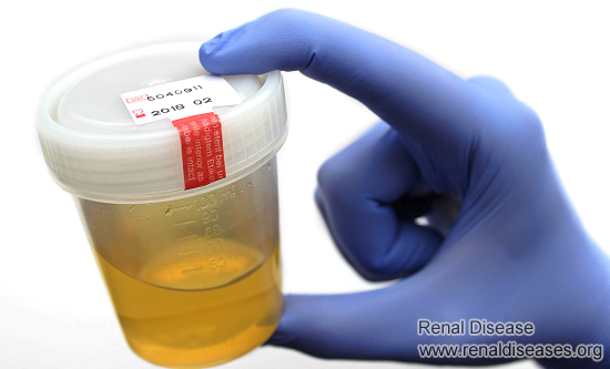 For Nephrotic Syndrome, Don’t Rush to Lower Proteinuria