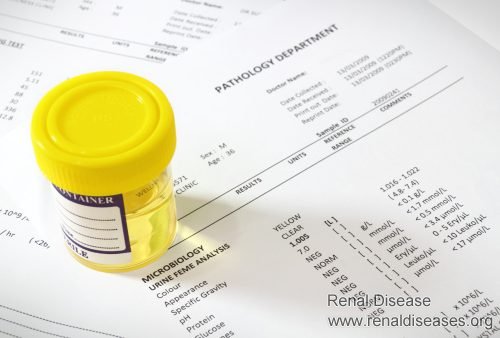 What Does Urine Albumin 3+ Mean When It Comes to Diabetes