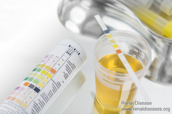 Three Common Causes of Proteinuria Relapse