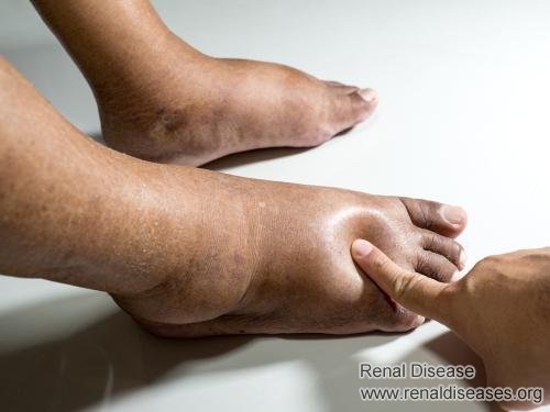 How Can Kidney Failure Cause Edema