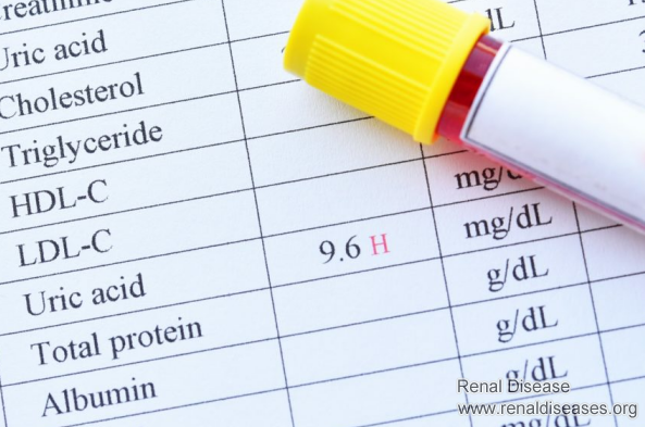 Hyperuricemia in IgA Nephropathy