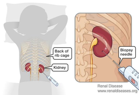 Why Do Some Nephrotic Syndrome Patients Need to Do Renal Biopsy